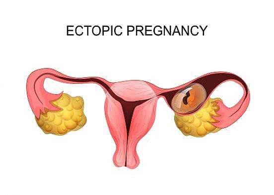 הריון חוץ רחמי הוא הריון שבו הביצית המופרית משתילה את עצמה מחוץ לרחם