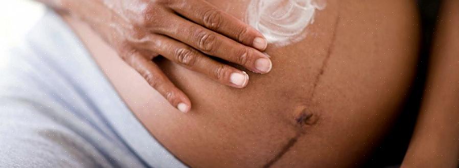 90% מהנשים ברחבי העולם יפתחו סימני מתיחה במהלך ההריון