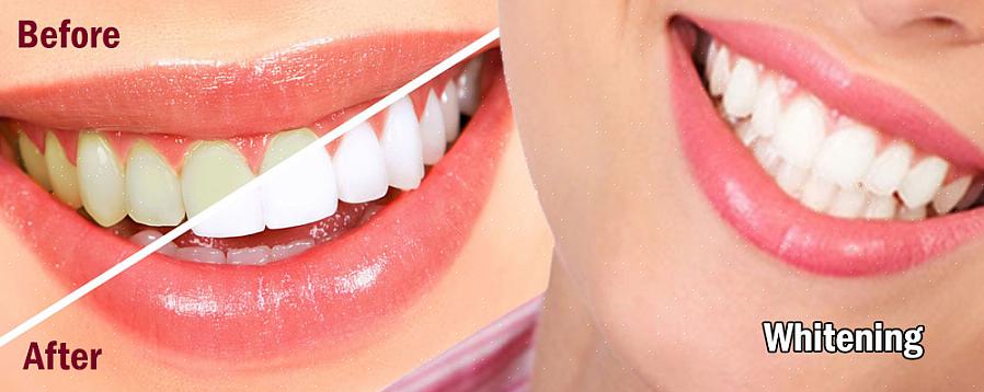 למה השיניים משנות את צבען