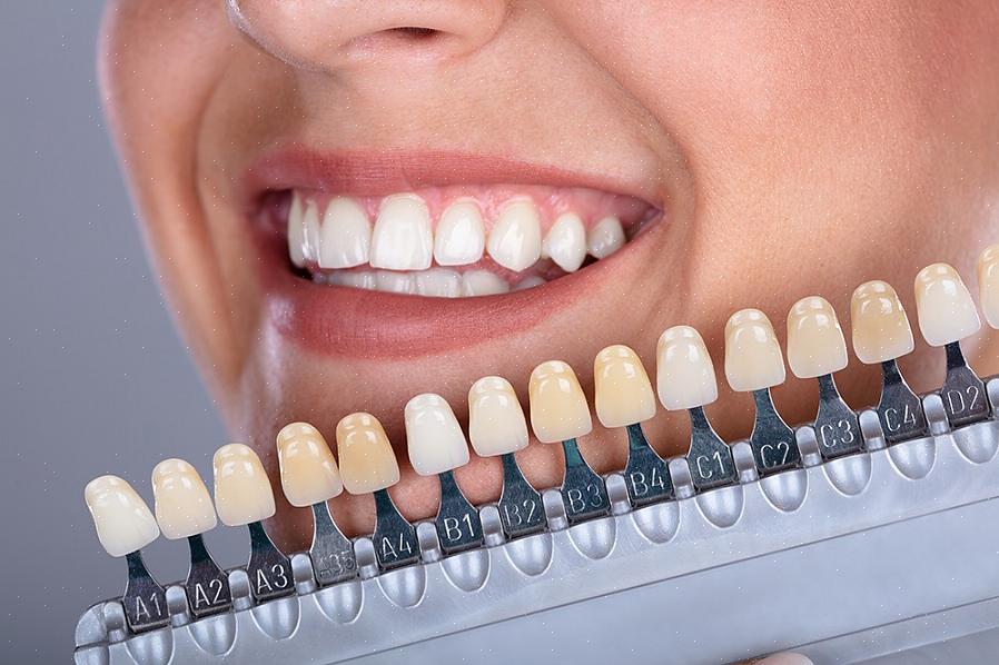 הגורמים שיכולים לגרום לשיניים שלנו לשנות את צבעם נפוצים מאוד