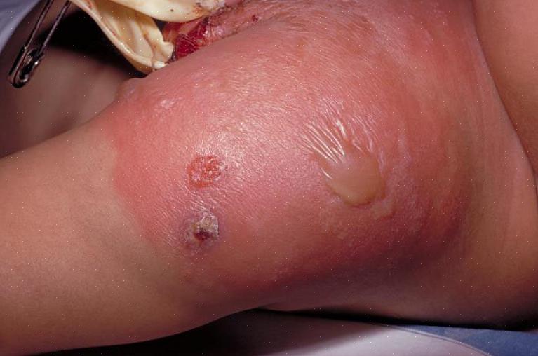צלוליטיס בילדים מוגדרת כדלקת חמורה של הדרמיס ושל הרקמה התאית התת עורית לאחר פגיעה (צריבה