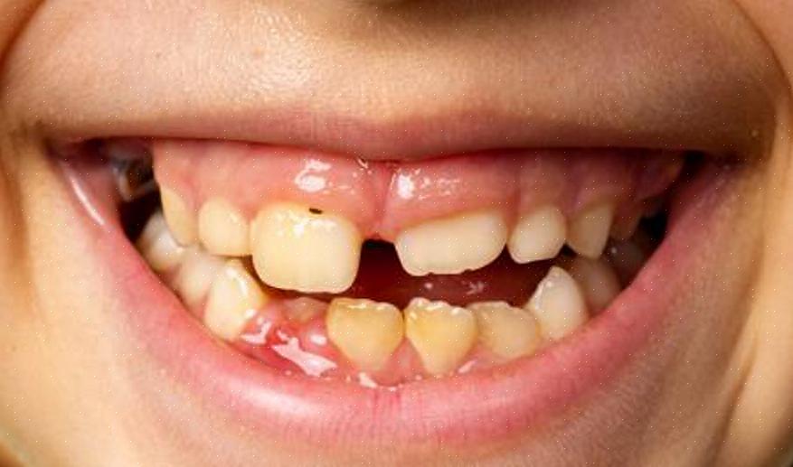 הופעת כתמים על שיניים קבועות היא תהליך טבעי שכולנו נחשפים אליו