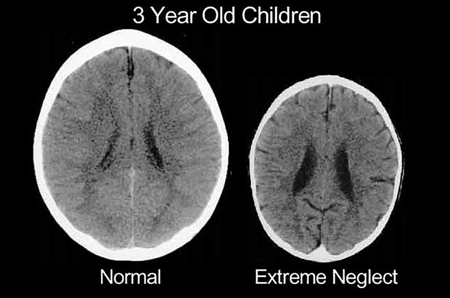 אם היינו יודעים כיצד סבל משפיע על מוחם של ילדים