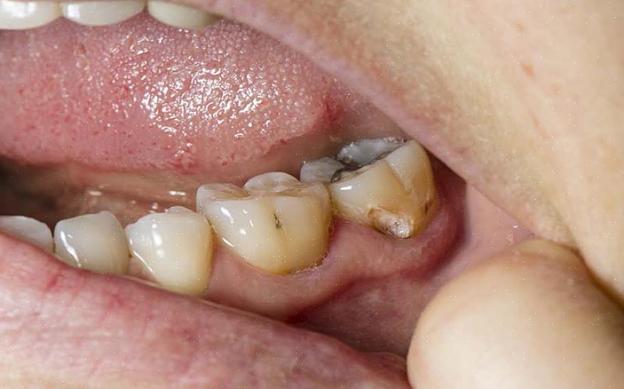 היום נדבר יותר בפירוט על מה הם חורים בשיניים ומה אתה יכול לעשות כדי למנוע אותם בילדים